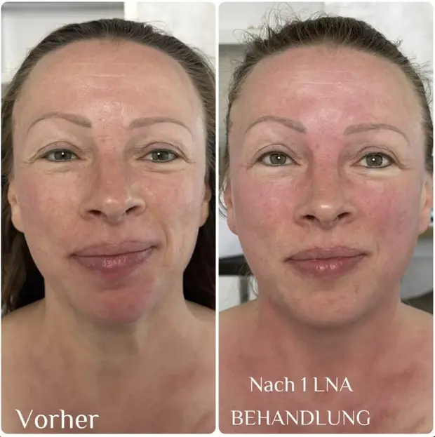 Vorher und nachher: Gesicht, Wangen- und Kieferbereich