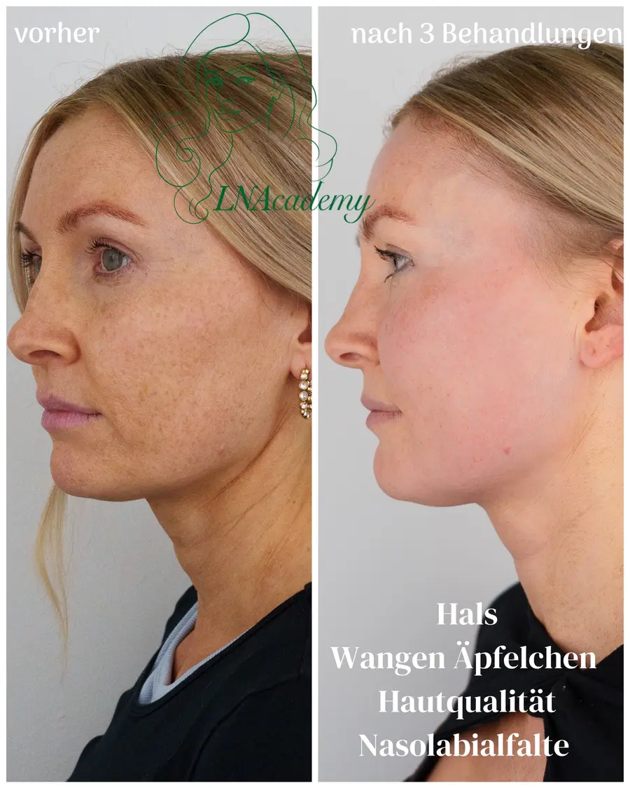 Vorher und nachher: Gesicht im Profil, nach drei Behandlungen